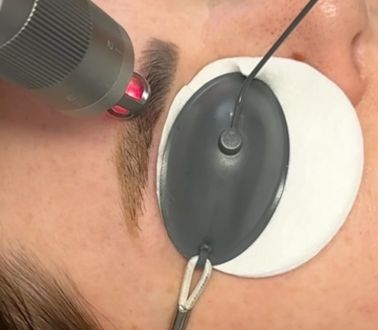 Here is a video of how I use my @skyncare.co.uk Laser device to remove unwanted SPMU Tattoo/Microbladed eyebrows!