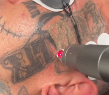 Face Tattoo get blasted by Laser