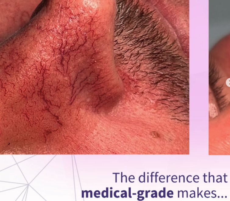 Nose veins after medical grade laser removal